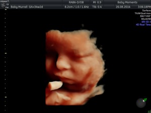 34 WKS 12 baby scan berkshire 